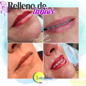 RELLENO DE LABIOS